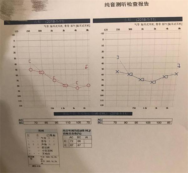 听力检测正常值是多少图片